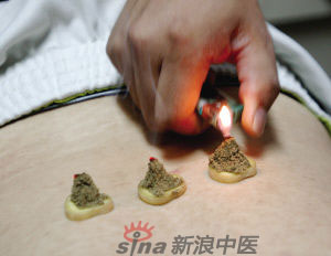 灸法的種類  你知道多少？